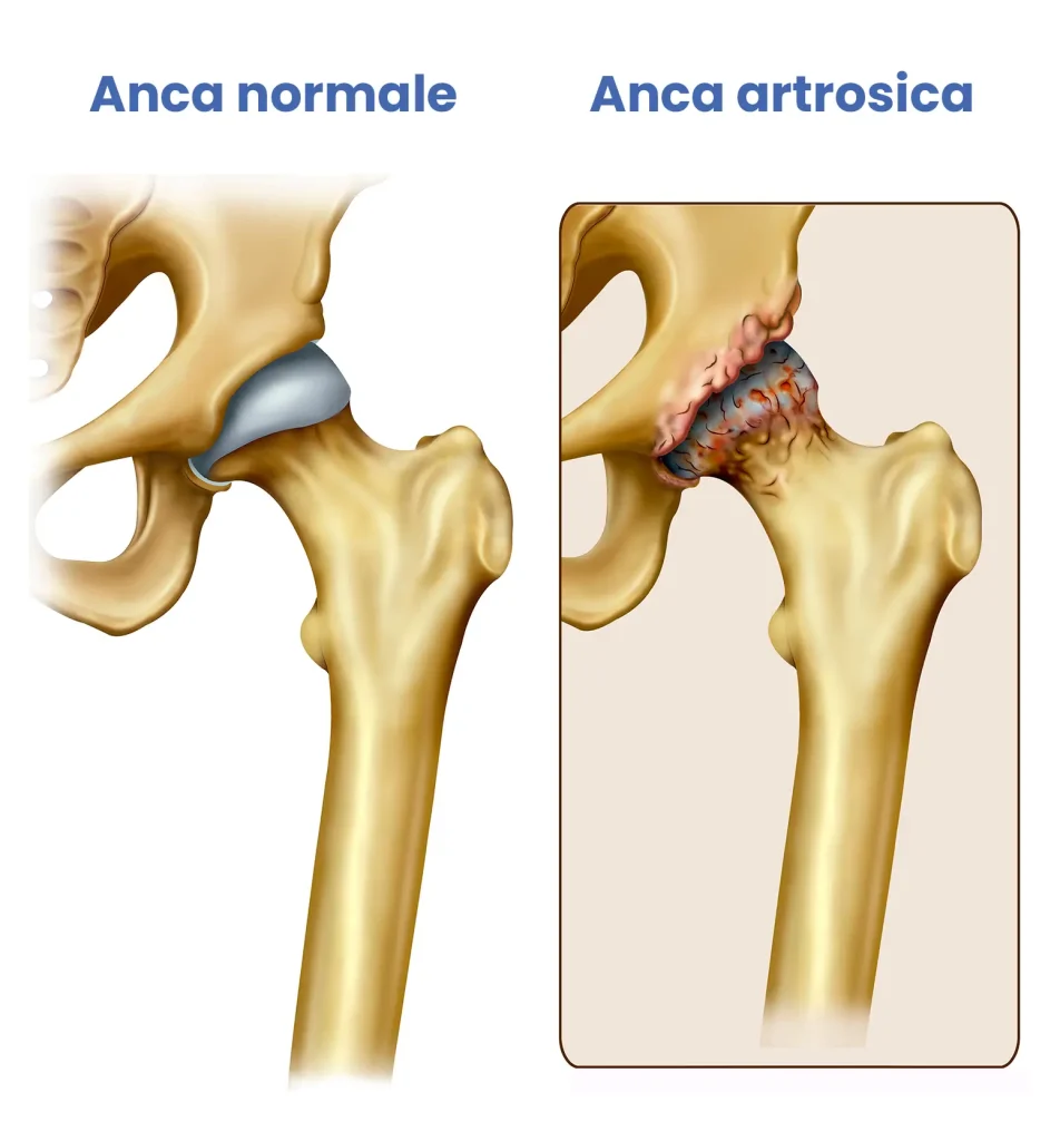 artrosi-anca-confronto