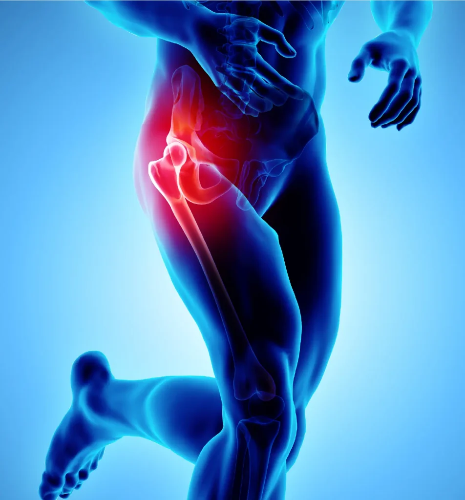 artrosi-anca-figura-gambe