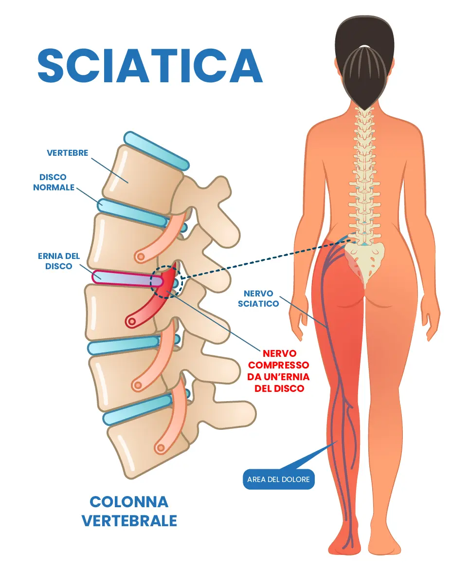 sciatica-1