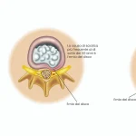 lombosciatalgia_cover