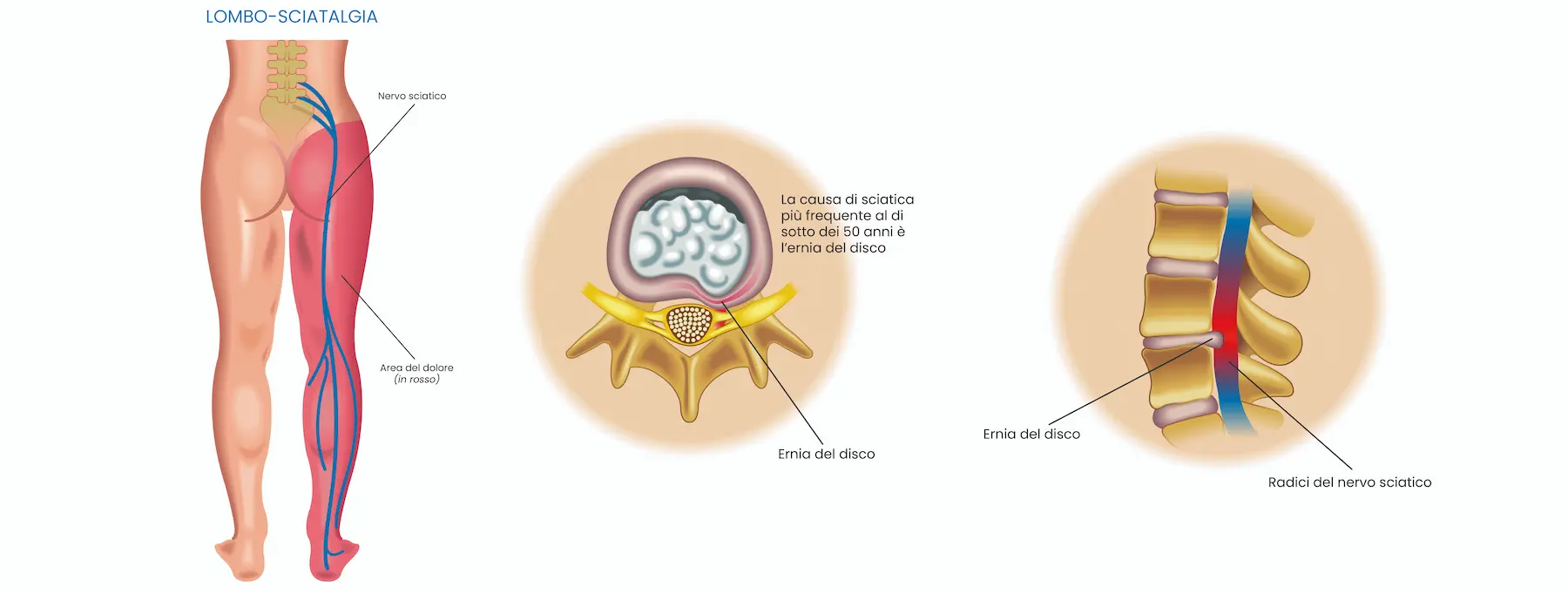 lombosciatalgia_cover