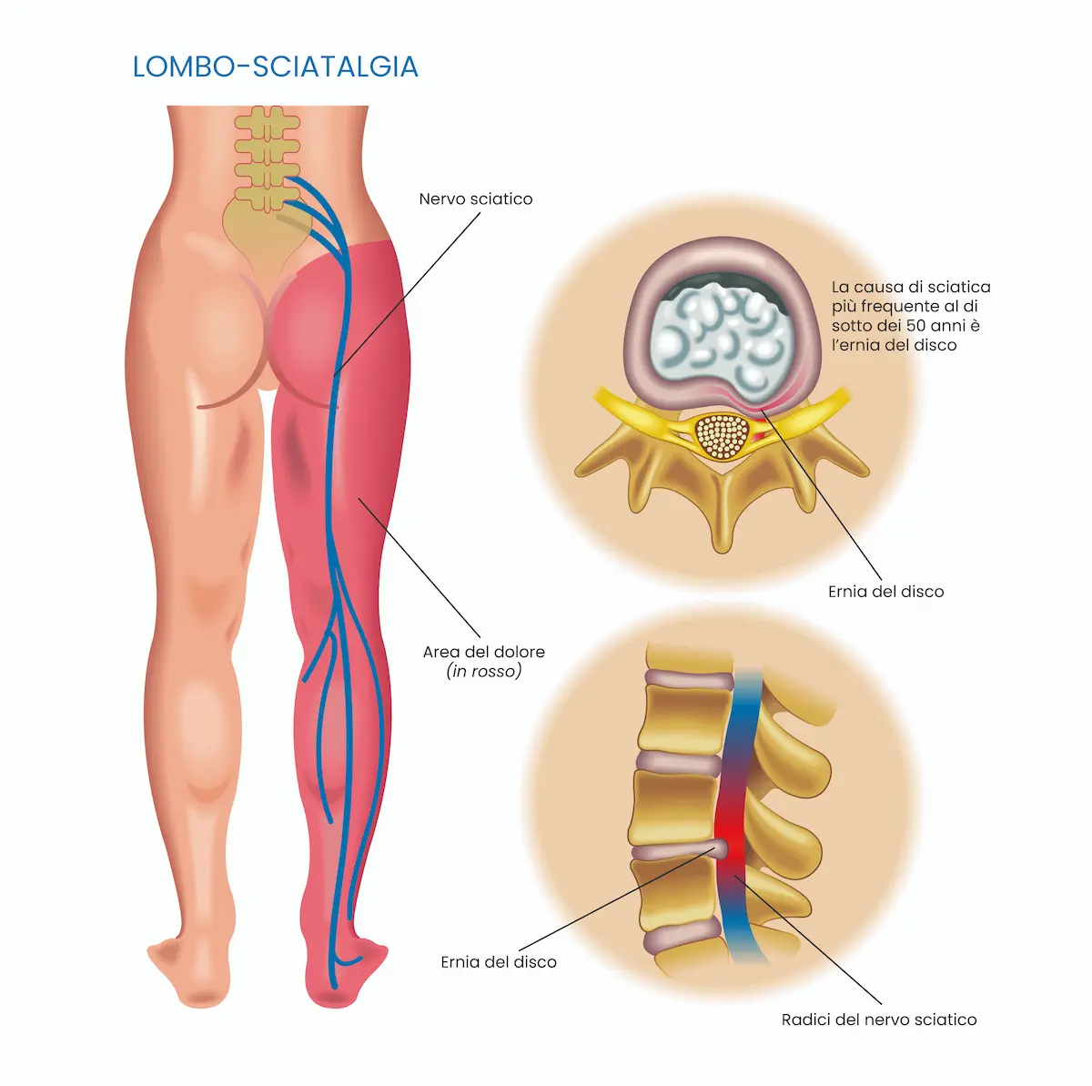 lombosciatalgia_1-3