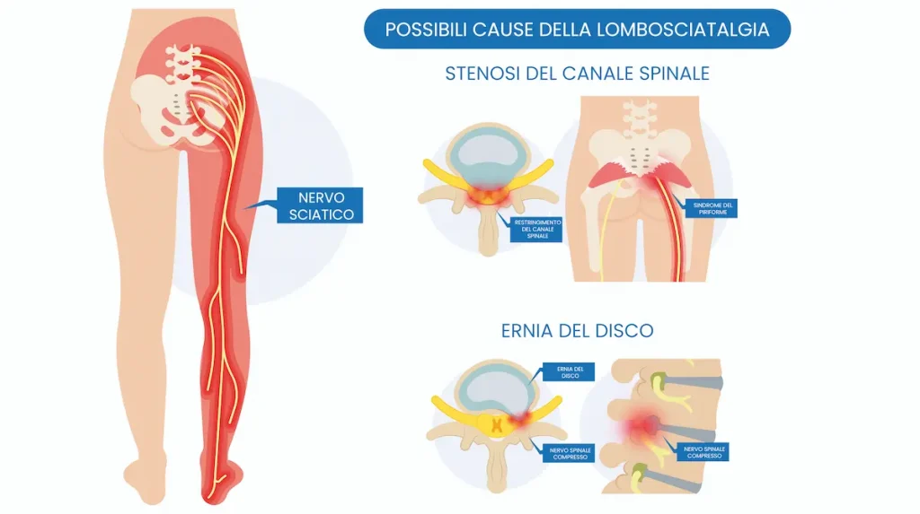 lombosciatalgia_2-3