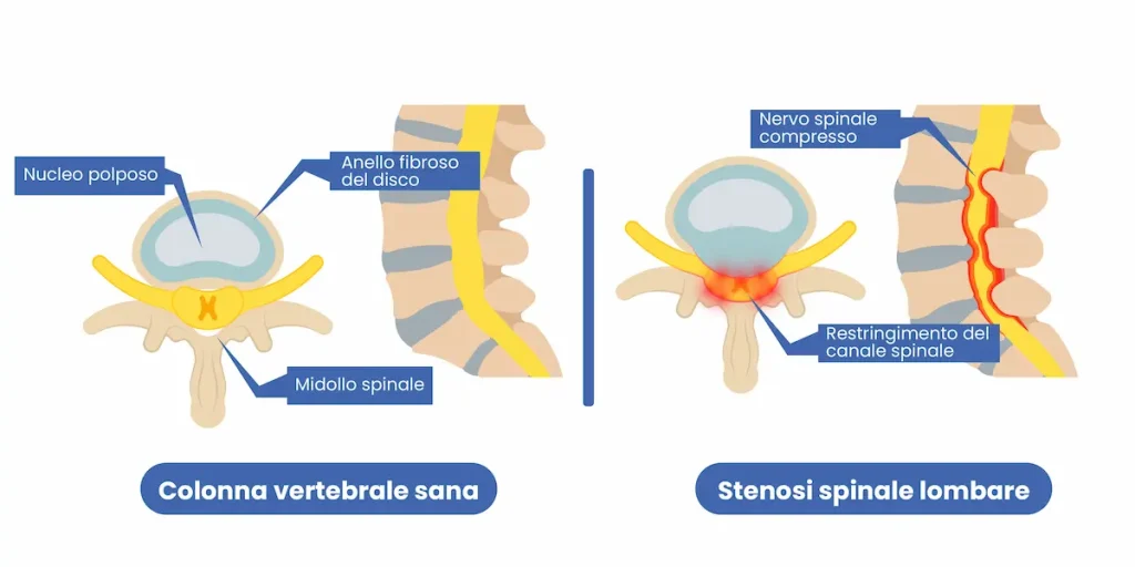 postoperatorio-stenosi-lombare-raffigurazione