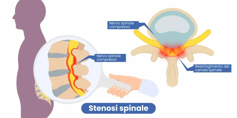 stenosi-lombare-raffigurazione