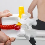 Protrusione discale: trattamento senza chirurgia Fisiorehab360 | Fisioterapia e fisioterapia in acqua a Carrara | Protrusione discale: trattamento senza chirurgia